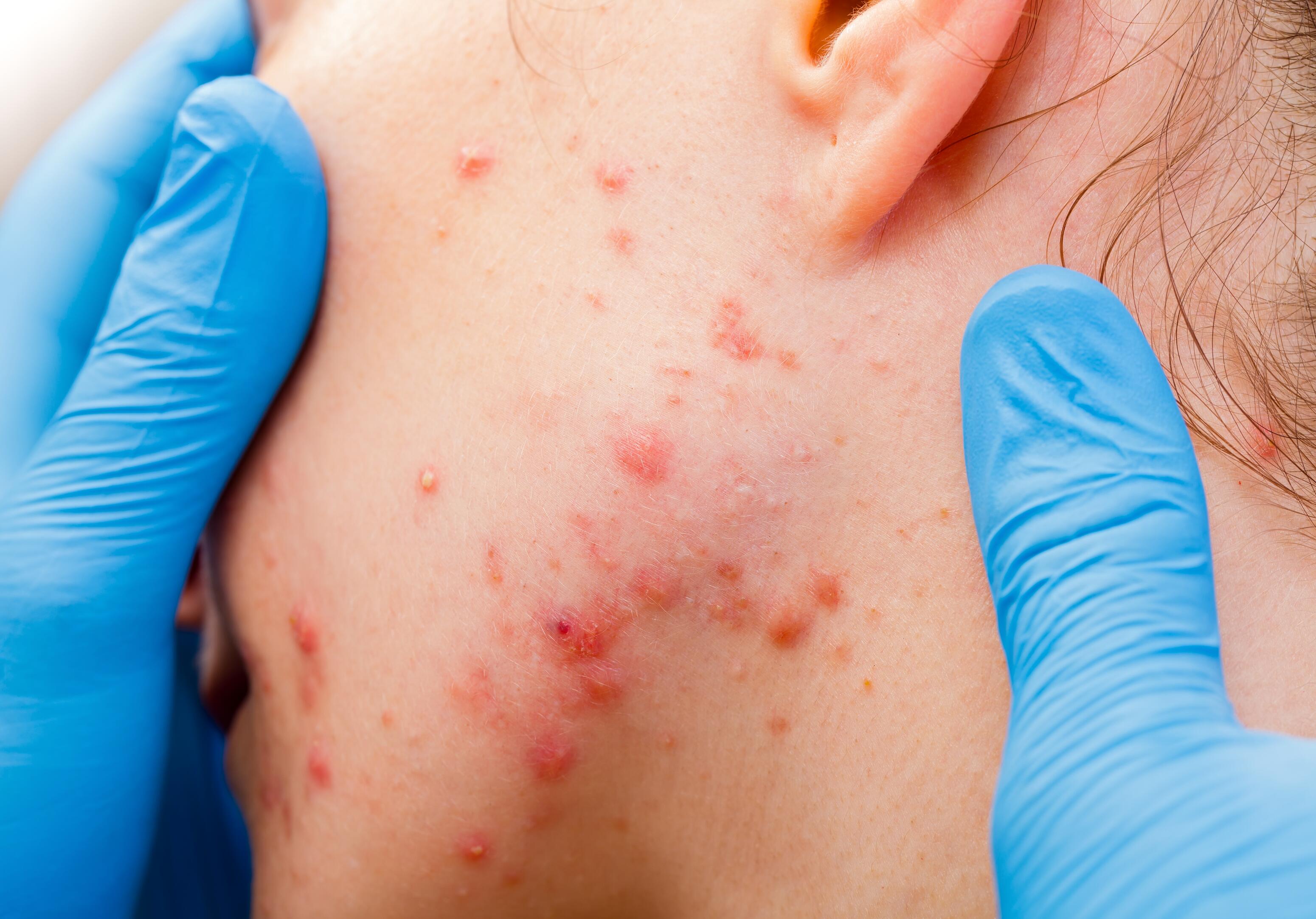 Entzündliche Akne: bakterielle Proliferation